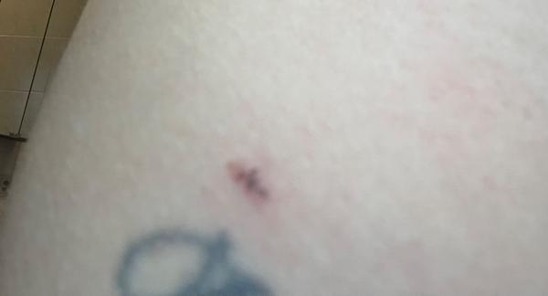 Zmizí jizvy po odstranění znamének laserem?