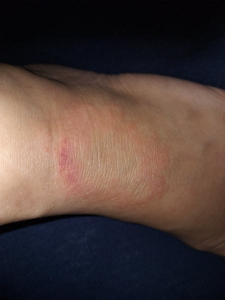 Červený flek na nártu. Borelióza, mykóza nebo něco jiného?