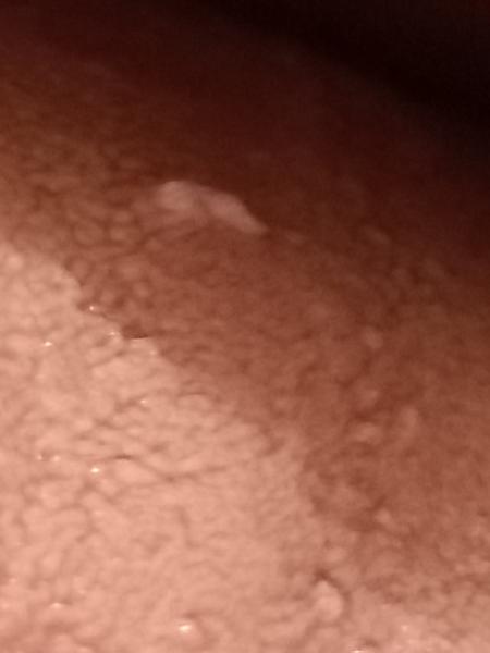 Co znamená bílá bradavice na jazyku?