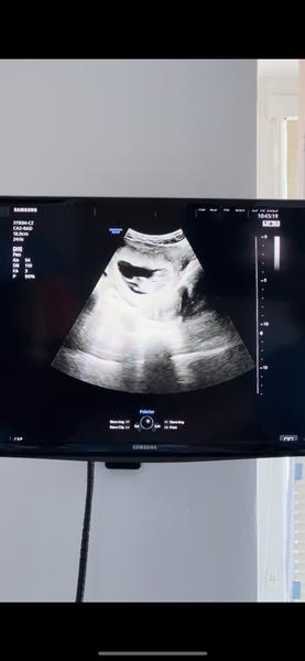 Pohlaví dítěte. Lze určit?