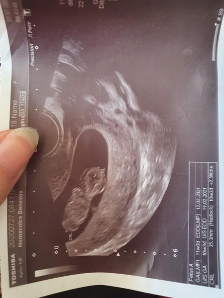 Ultrazvuk. Vidím obličej miminka?