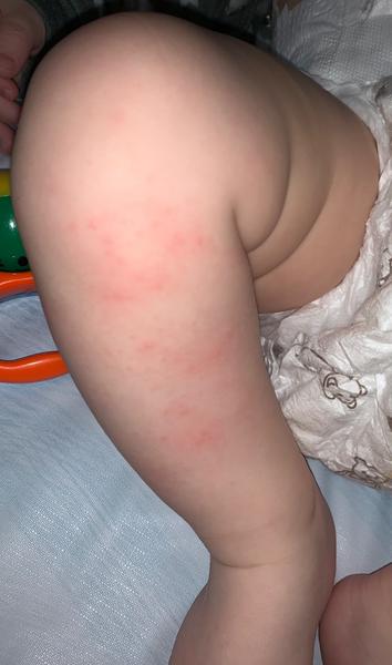 Zkušenost s vyrážkou na nohou u kojenců?