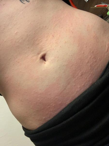 Svědivé pupínky na břiše. Jaké jsou zkušenosti?