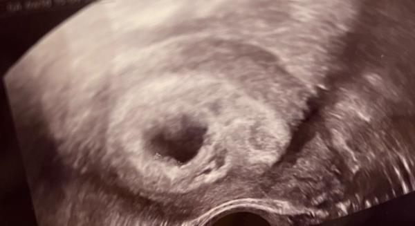 Zkušenosti s nejasnou srdeční akcí v 6. týdnu těhotenství?