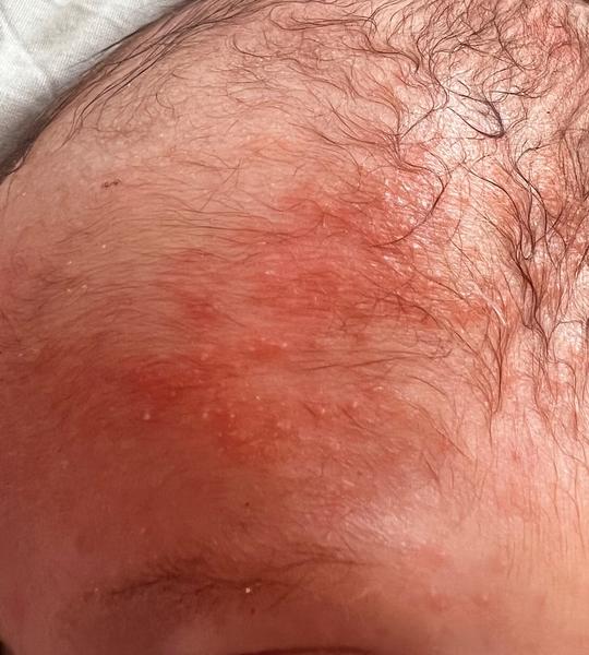 Co způsobilo vyrážku u měsíčního kojence?