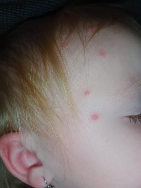 Pupínky. Je možné, že jsou to neštovice?