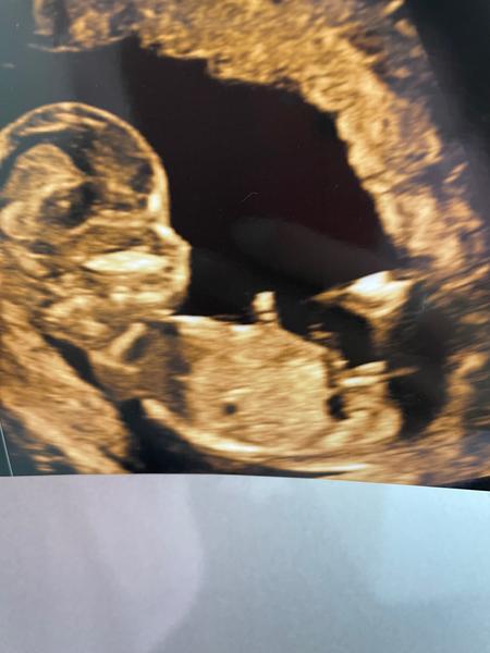 Je možné odhadnout pohlaví ve 14. týdnu těhotenství?