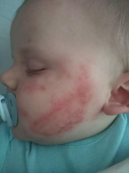 Ekzém. Poradíte, prosím?