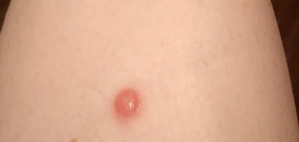 Stále se mi objevuje stejný problém na noze