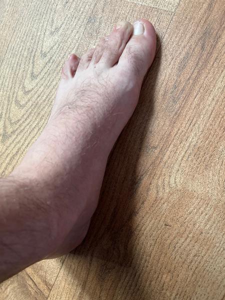 Jak odhalit plochou nohu a mohu ji léčit?