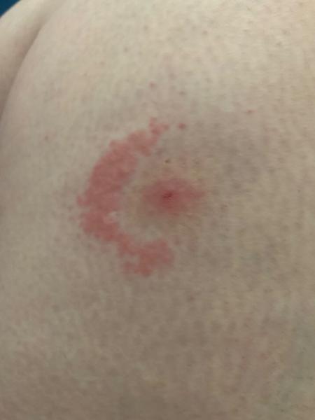 Může to být borelióza?