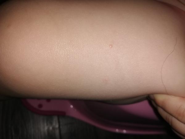 Pupínky u batolete, které nesvědí