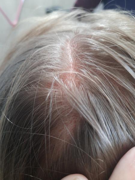 Červená kůže cihlové barvy ve vlasech. Je to opět seborea?