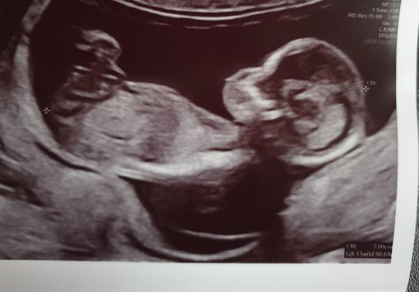 Pohlaví miminka. Poznal byste?