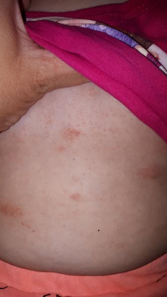 Ekzém (kvasinka) nebo alergie?