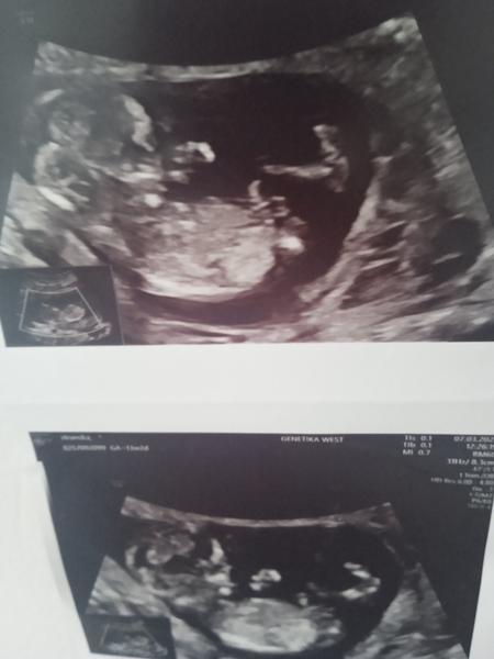 Mění se podle vás pohlaví dítěte na ultrazvuku?