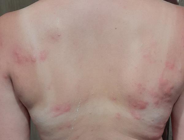 Svědivé pupínky po těle: Jaké jsou možné příčiny?