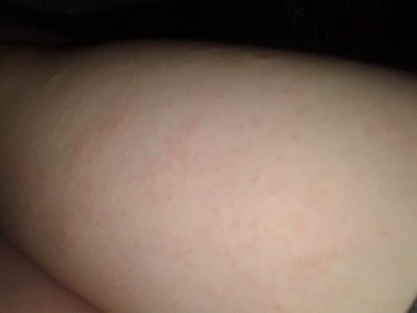 Vyrážka. Co to je?