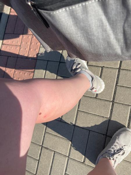 Alergická reakce na klíště nebo počínající infekce?