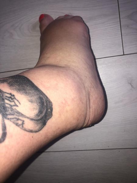 Jak řešit otoky nohou ve 24. týdnu těhotenství?