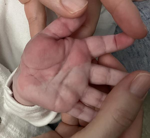 Oteklá, červená a teplá dlaň. Máte s tím, prosím, zkušenost?