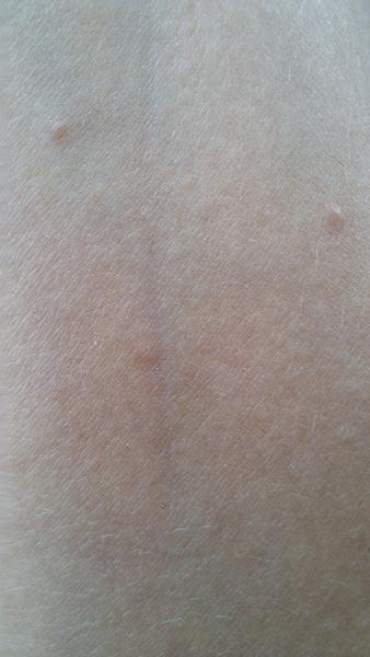 Pupínky na rukou. Může být příčinou scuhá pokožka?