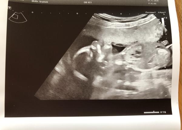 Poznáte pohlaví miminka podle utz z 1. i 2. trimestru?