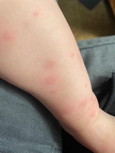 Příčiny mizejících fleků u dětí. Co funguje na vyrážky?