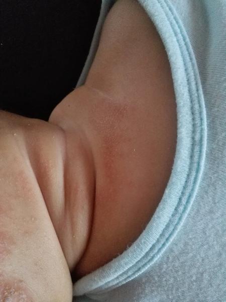 Přesný postup ošetření při ekzému 3měsíčního miminka