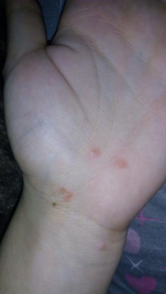 Vodnaté svědivé puchýřky, máte zkušenost?