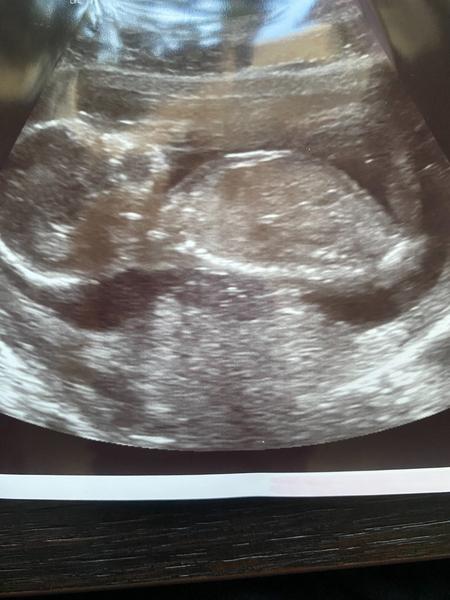 Jaké pohlaví tipujete podle pohlavního hrbolku?