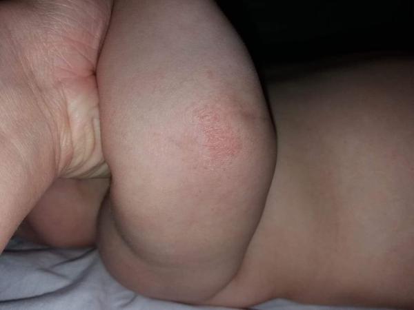 Ekzém. Co by pomohlo?