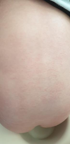 Ekzém. Může se o něj jednat, nebo je to jiná vyrážka?