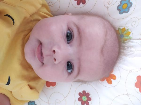 Hemangiomy u miminka - máte zkušenosti? Jak jste je léčili?