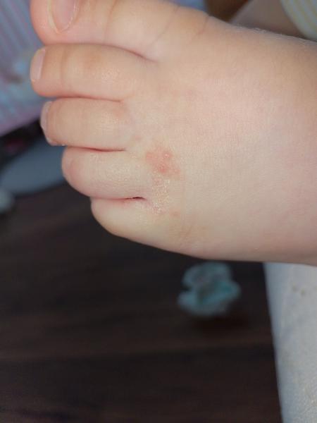 Vyrážky na noze dítěte. Co může být příčinou a jak léčit?