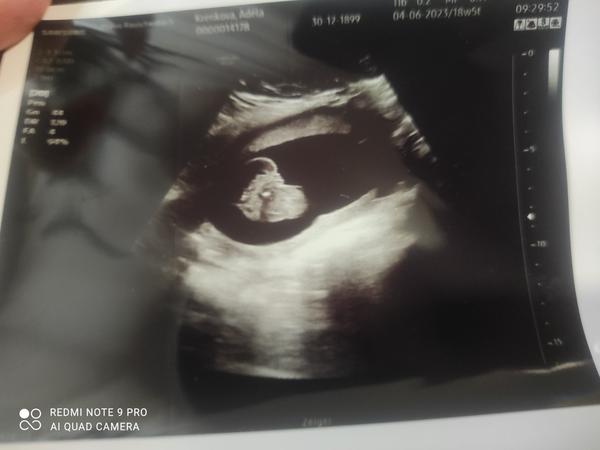 Je to holka nebo kluk? Nejistota po vyšetření ultrazvukem.