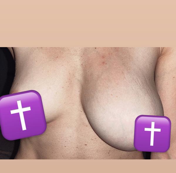 Rovnoměrná velikost prsou po porodu. Jak dosáhnout symetrie?