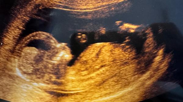 1. screening. Je zakroužkovaná oblast pohlavní pahorek?