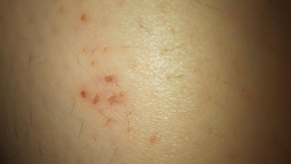 Co dělat s rozškrábanou vyrážkou na lýtku?