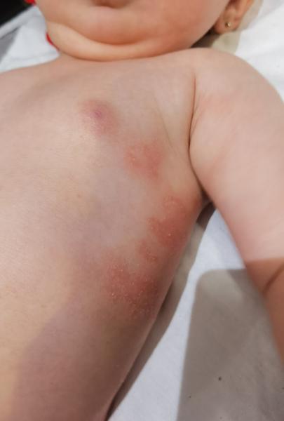 Červené fleky u batolete. Poradíte, co dělat?