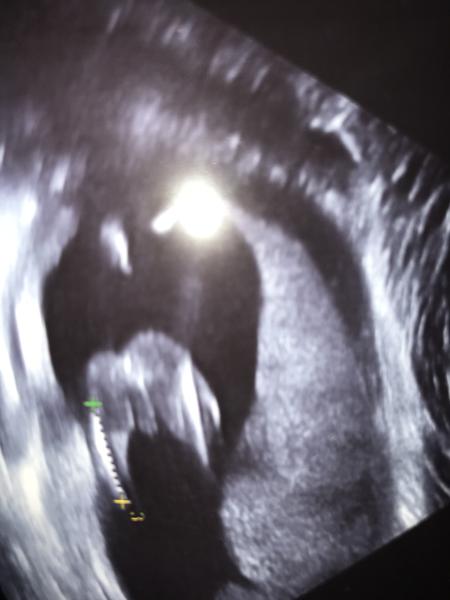 Pohlaví dvojčat, co myslíte?