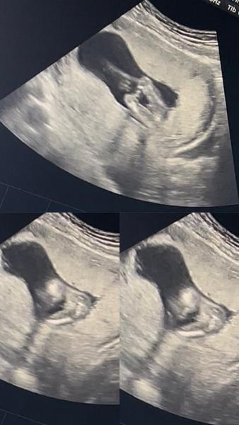 Jak poznat pohlaví dítěte podle ultrazvuku?