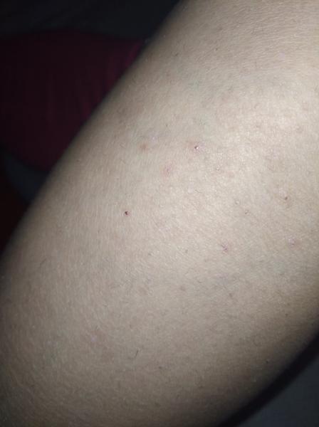 Svědění nohou: Jak rozeznat, zda je to svrab?