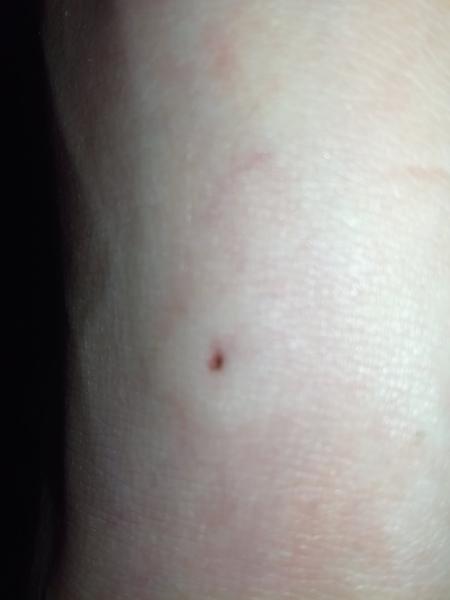 Může to být klíště?