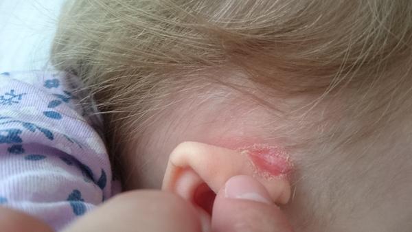 Mokvající místo za uchem. Jak se toho zbavit?