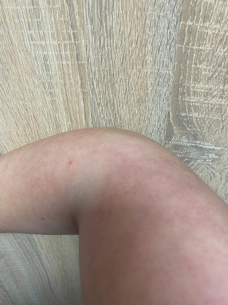 Mramorová kůže: Je to zdravotní problém?