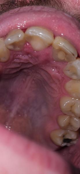 Co znamená zduřenina na dásni s bodkou?