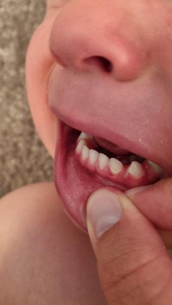 Bílý povlak kolem zubu u dítěte. Co to může být?