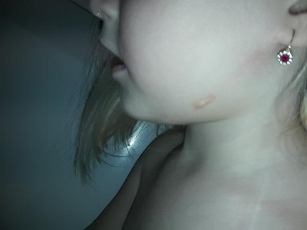 Flíček na kůži po zlatém stafylokokovi