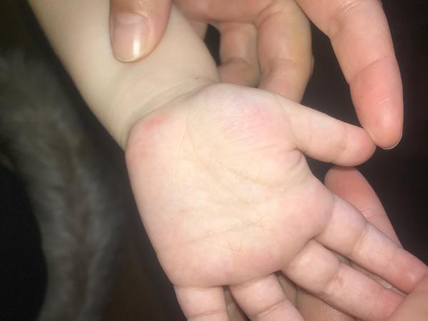 Syn má parainfekční virózu. Z čeho by to mohlo být?